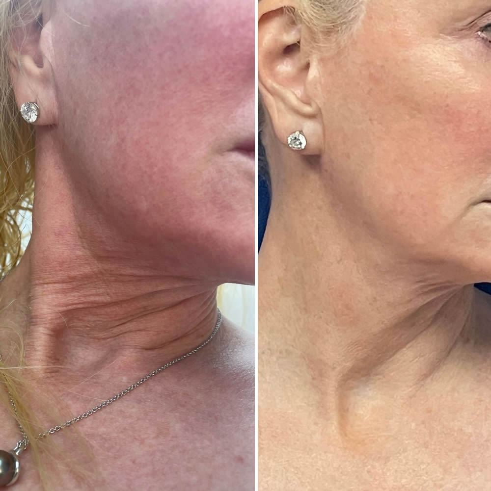 Before and 24 hours post microneedling and Luxir applied topically.